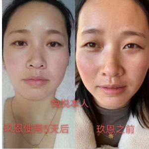 ��������ʯ���ഺ����Һ��Ч��