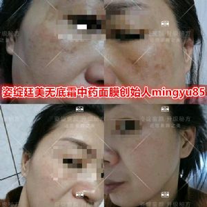 Ψ���޴������޵�˪����ҩ��Ĥ�ǰ�ȫ�ģ�